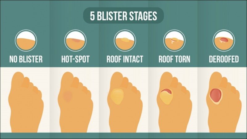 blister stages